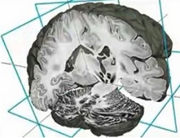 Учёные обнаружили в мозге биологический регулятор памяти